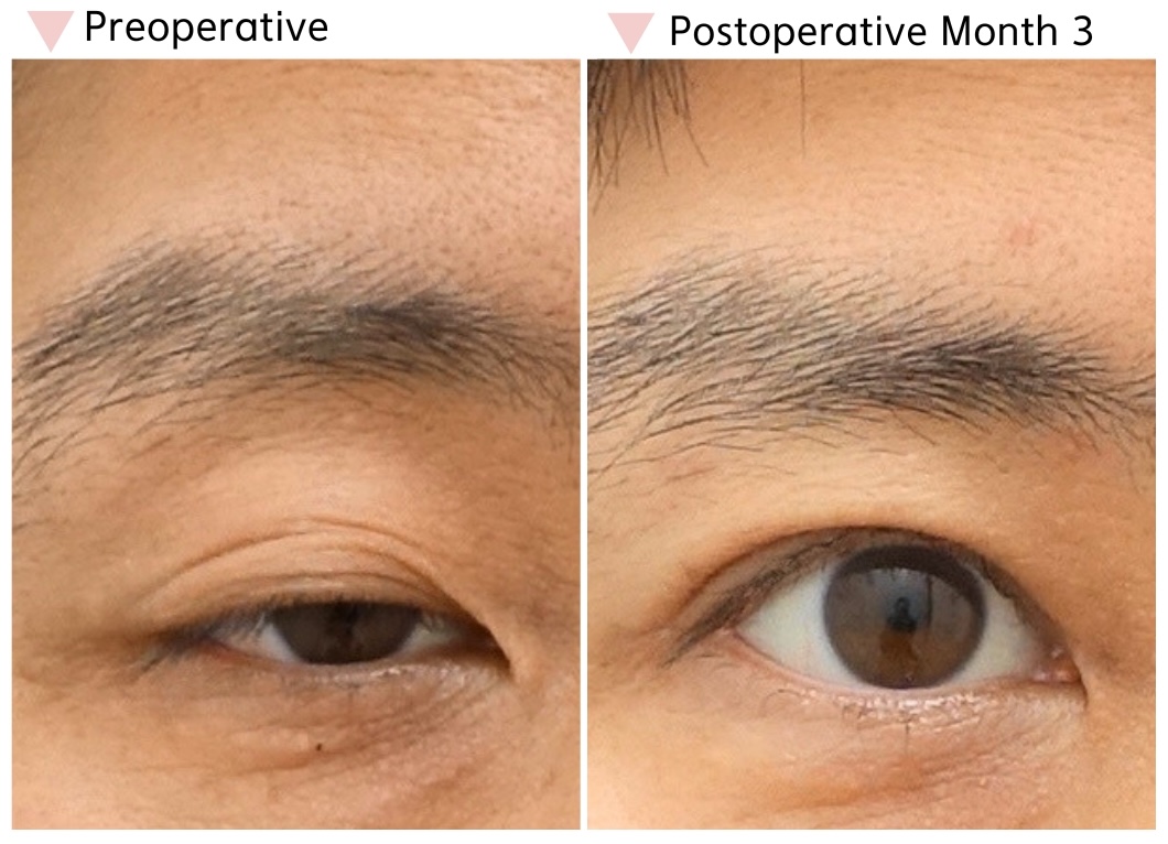 Male ptosis correction in Korea before and 3 months after surgery showing improved eyelid opening
