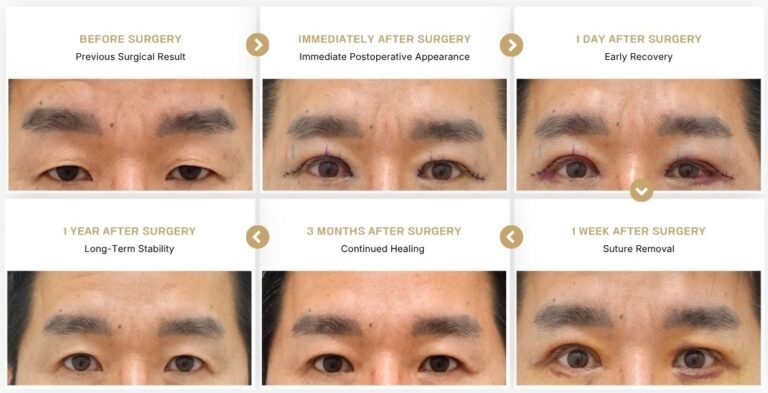 Male ptosis surgery recovery timeline showing before surgery, immediately after surgery, 1 day, 1 week, 3 months, and 1 year after surgery.