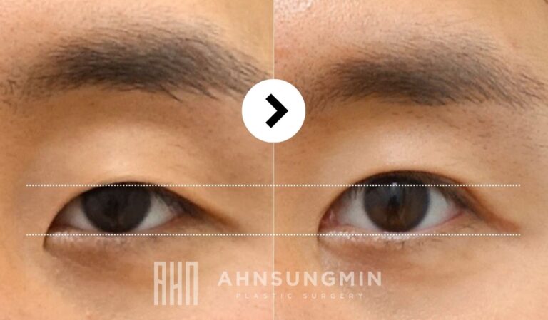 Comparison of iris exposure before and after male ptosis correction showing improved eye opening in Korea