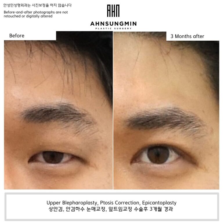 Before and 3 months after male ptosis correction showing reduced forehead compensation and improved natural eyelid opening.