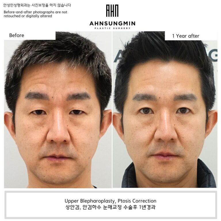 Before and 1 year after male ptosis surgery showing improved eyelid symmetry and long-term functional stability.