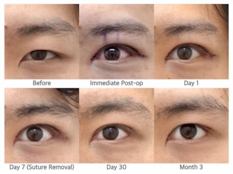 Ptosis Surgery Recovery Timeline: What to Expect From Day 1 to Month 3.