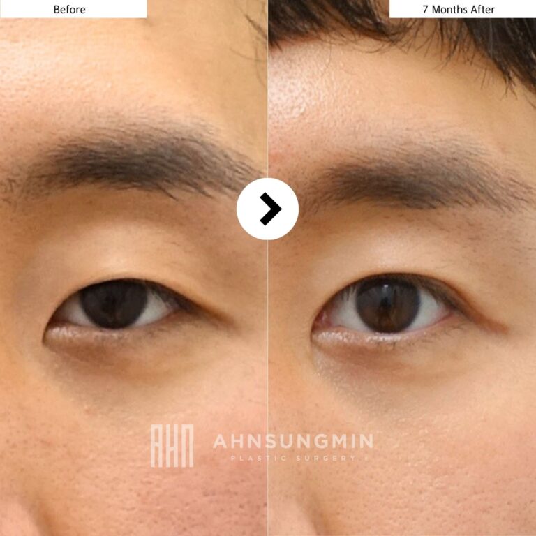 Before and after male ptosis correction for sleepy eyes in Korea showing natural improvement in eye opening