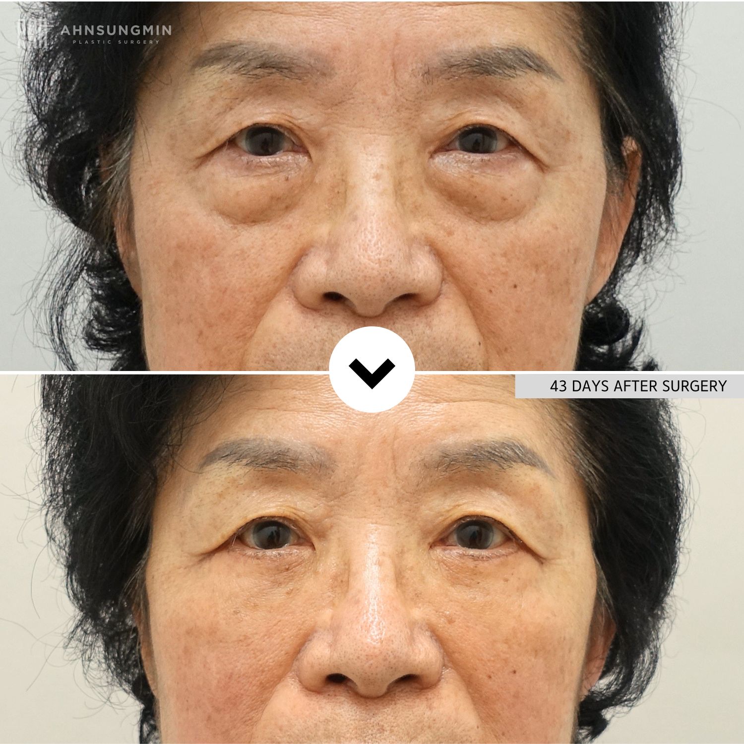Before and 43 days after lower blepharoplasty in a mature patient showing reduced under-eye bags and improved lower eyelid contour.