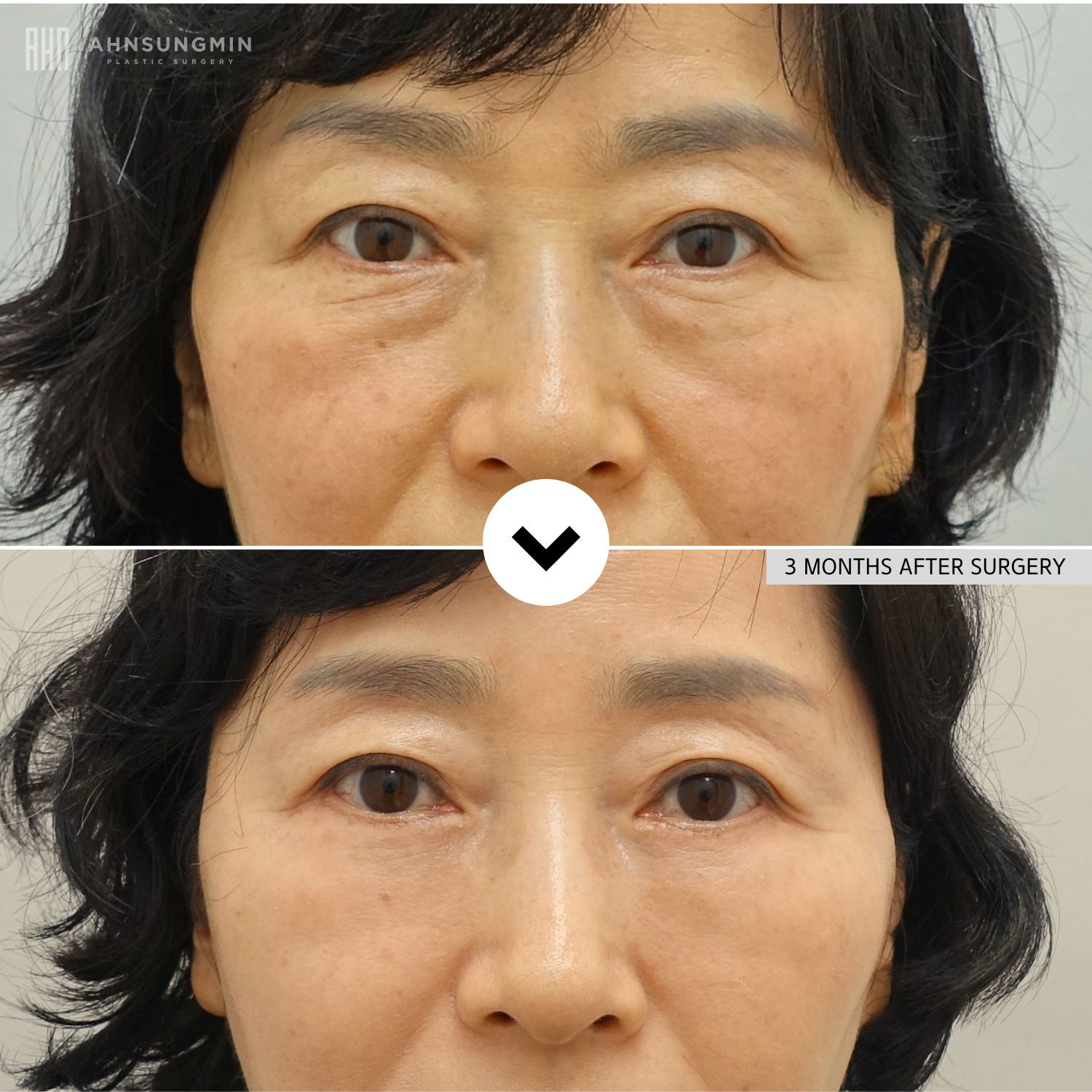 Before and 3 months after lower blepharoplasty in a mature woman showing reduced under-eye bags and smoother lower eyelid contours.