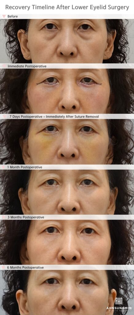 Lower blepharoplasty recovery timeline in a middle-aged woman from immediately after surgery to 6 months