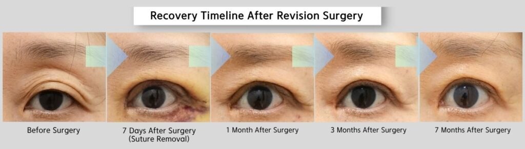 Recovery timeline after revision surgery for multiple eyelid folds in Korea from before surgery to 7 months postoperative