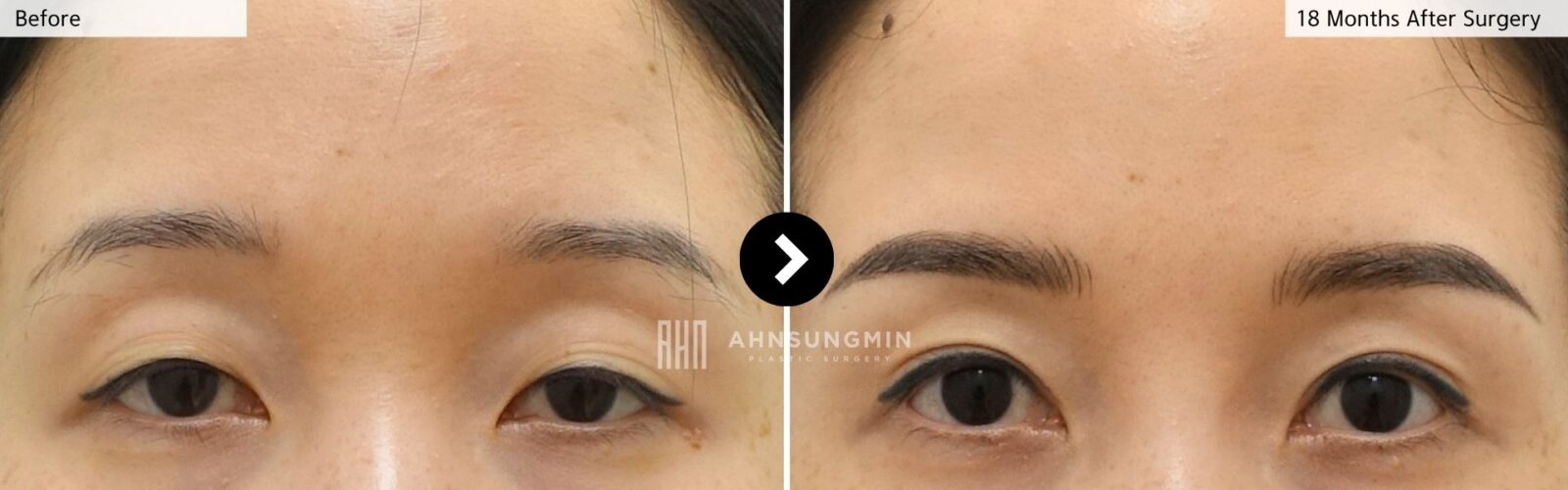 Before and 18 months after multiple fold revision eyelid surgery in Korea showing a stable single eyelid crease and improved symmetry.