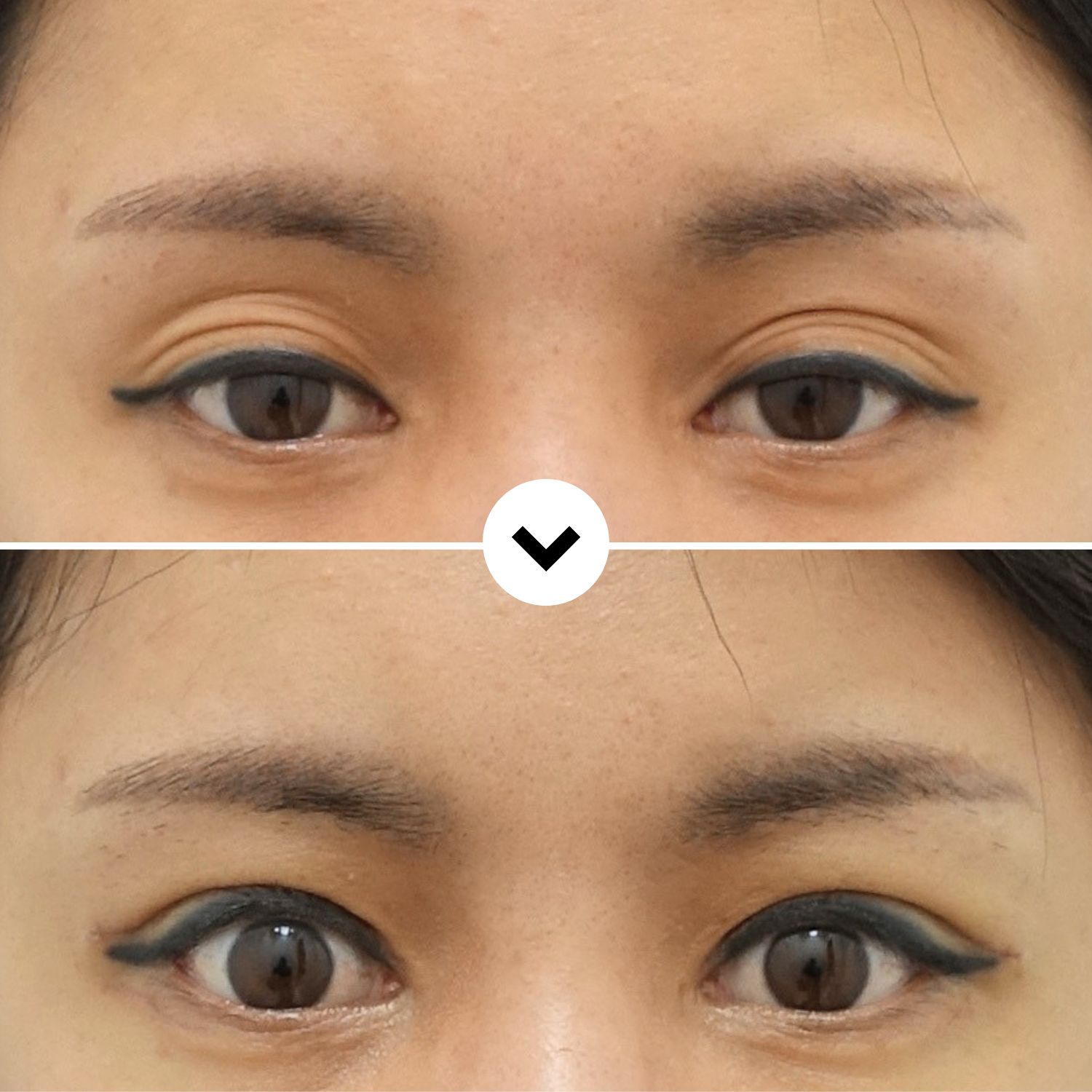 Before and after multiple fold revision eyelid surgery showing correction of multiple eyelid creases into a single natural-looking crease.