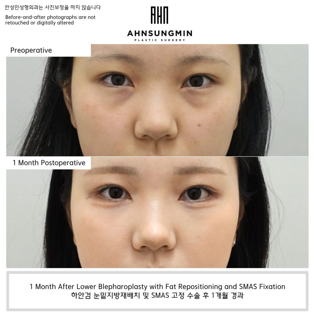 Before and 1 month after natural lower blepharoplasty with fat repositioning and SMAS fixation in Korea preserving the aegyo-sal