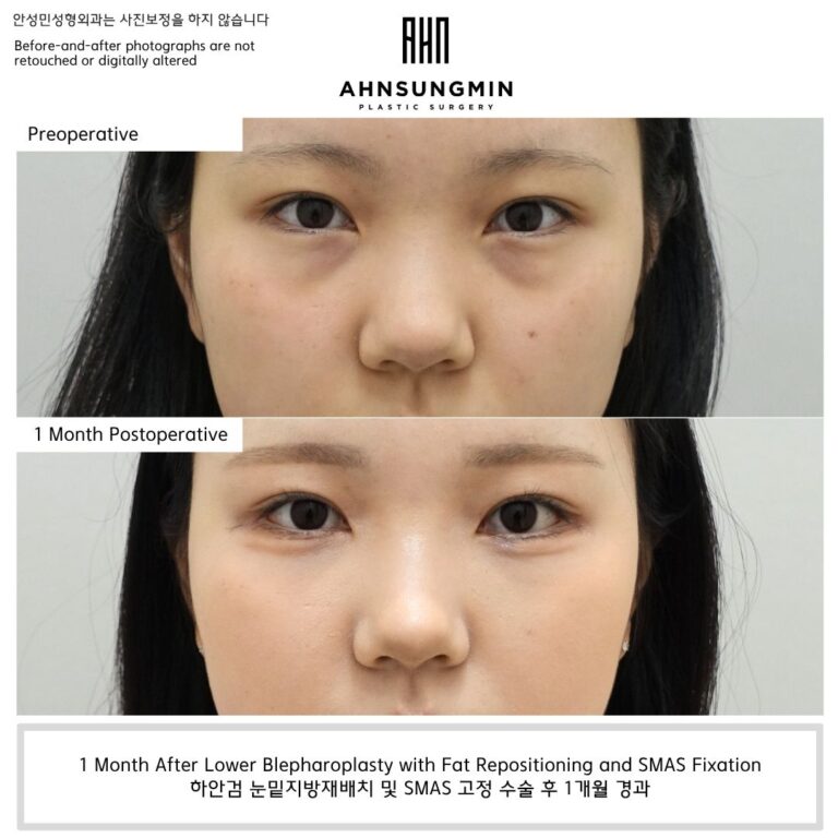 Before and 1 month after natural lower blepharoplasty with fat repositioning and SMAS fixation in Korea preserving the aegyo-sal