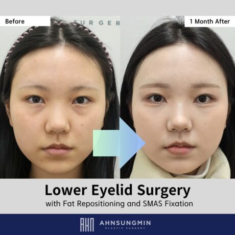 The Importance of Preserving the Aegyo-Sal in Lower Blepharoplasty in Korea