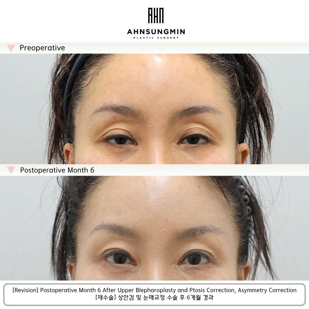 6 months after ptosis asymmetry correction surgery showing improved eyelid balance and natural symmetry