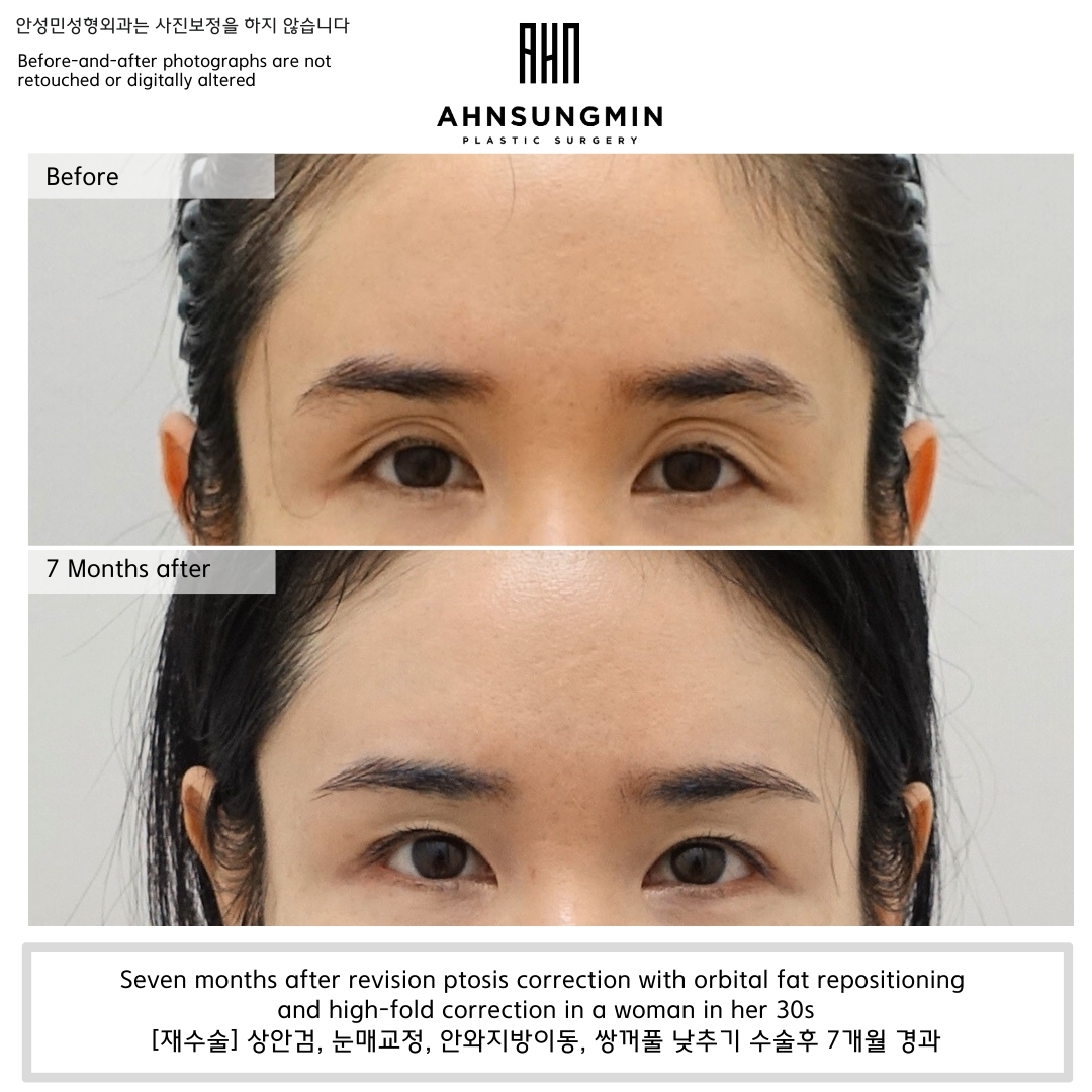 Before and seven months after revision ptosis correction with orbital fat repositioning and high-fold correction in a woman in her 30s