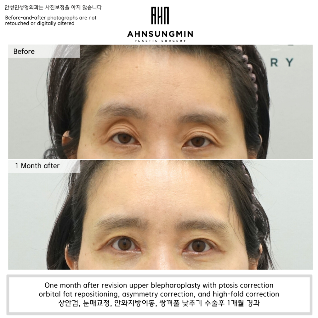 Revision upper blepharoplasty with ptosis correction and orbital fat repositioning, before and one month after surgery in Korea