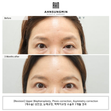 Herings’ law must be taken into consideration when performing eye surgery for ptosis.