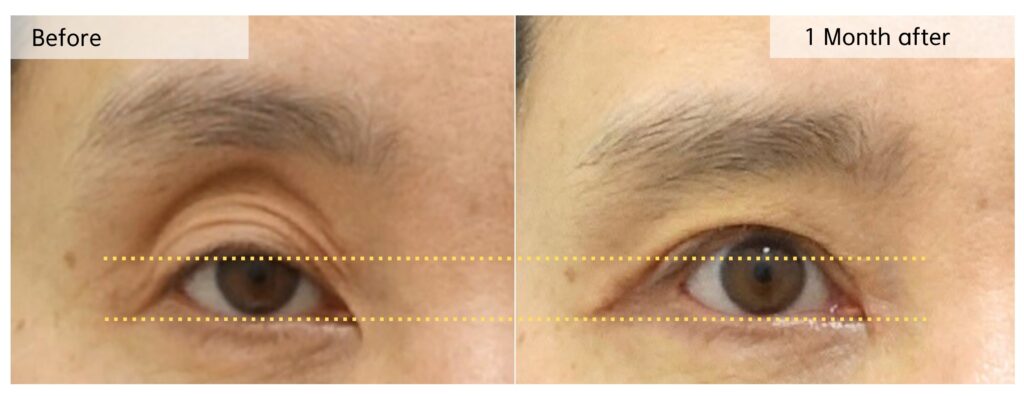 Before and 1 month after ptosis correction showing improved eyelid opening and reduced hollow upper eyelid appearance through structural balance restoration