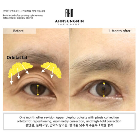 When Eyelid Hollowing Is Worsened by Ptosis Asymmetry.