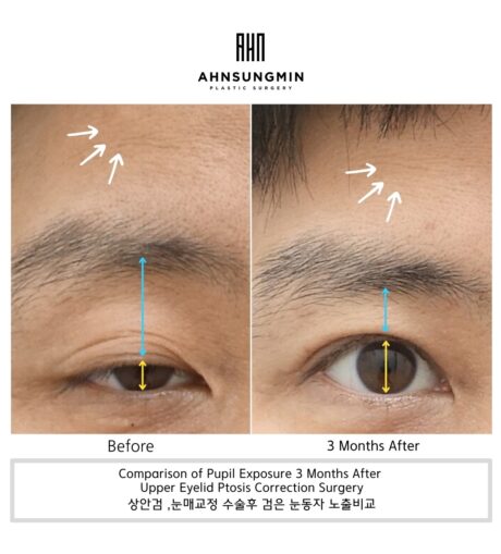 When Eye Shape Correction Is Necessary.