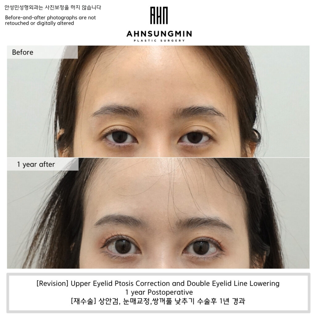 [Revision] Upper Eyelid Ptosis Correction and Double Eyelid Line Lowering – 1 Year Postoperative