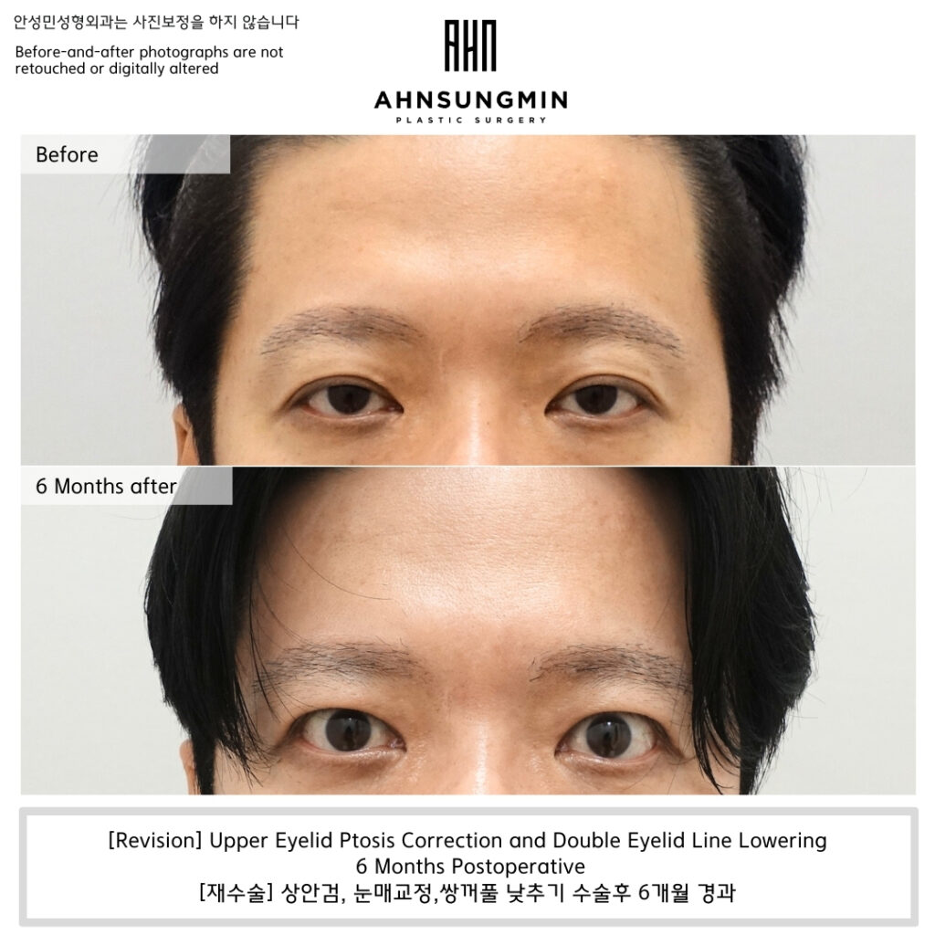 Revision upper eyelid ptosis correction and double eyelid line lowering before and 6 months after surgery