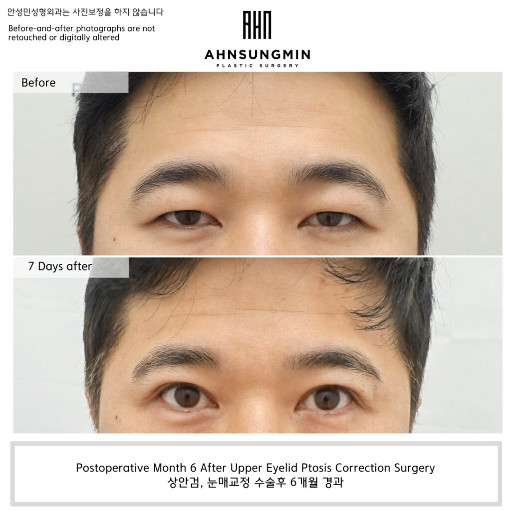 Why We Focused on Functional Eyelid Opening Rather Than Making the Eyes Bigger.