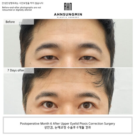 Why We Focused on Functional Eyelid Opening Rather Than Making the Eyes Bigger.