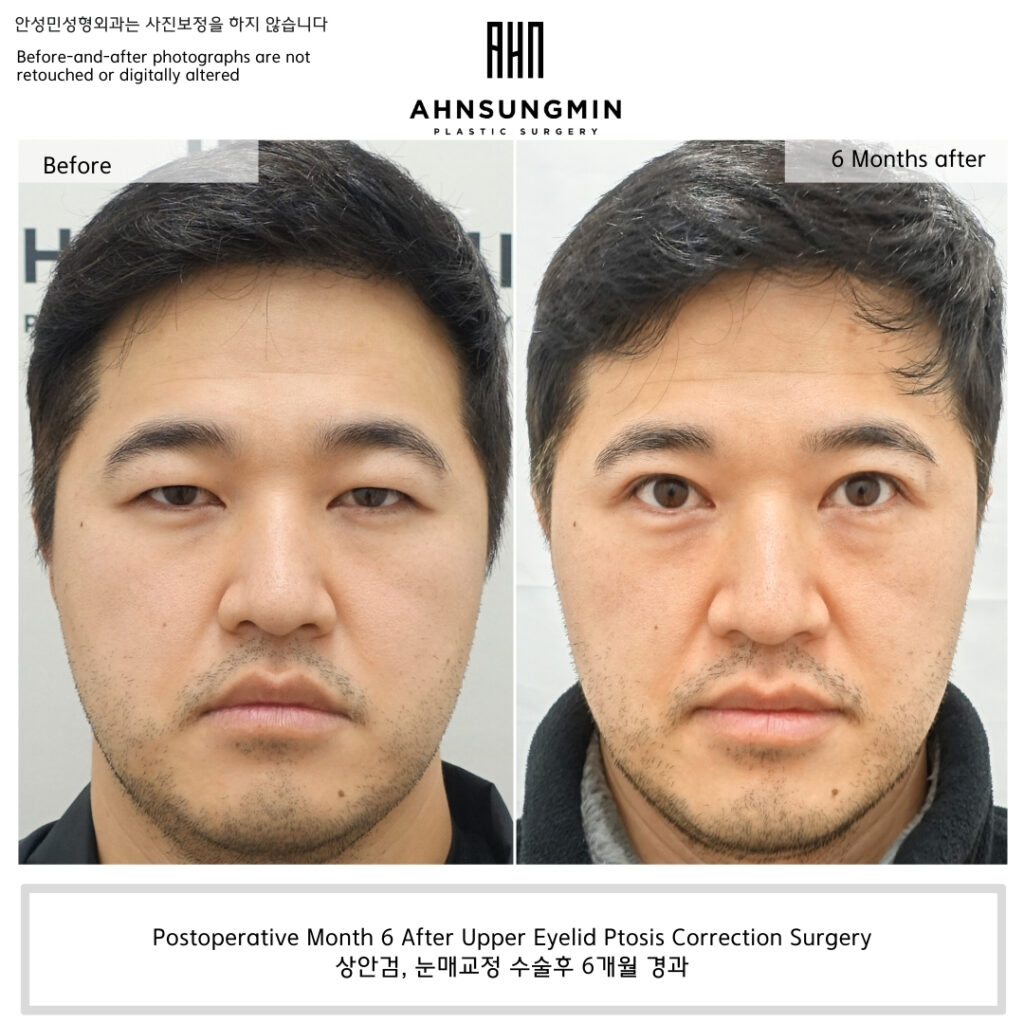 Postoperative Month 6 after upper eyelid ptosis correction surgery showing improved eyelid opening and natural symmetry in a male patient