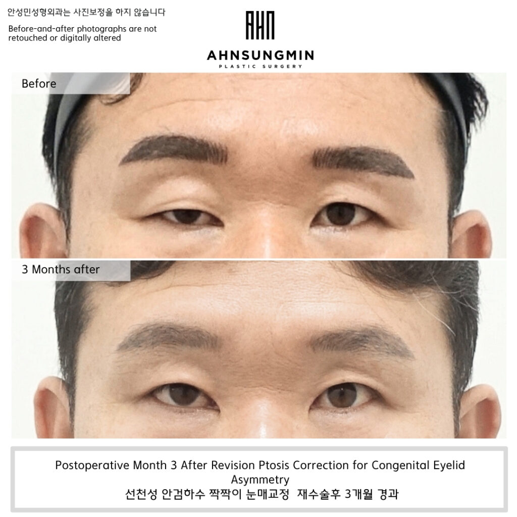 When We Try to Achieve Symmetry in Ptosis Correction.