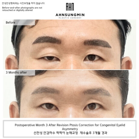When We Try to Achieve Symmetry in Ptosis Correction.
