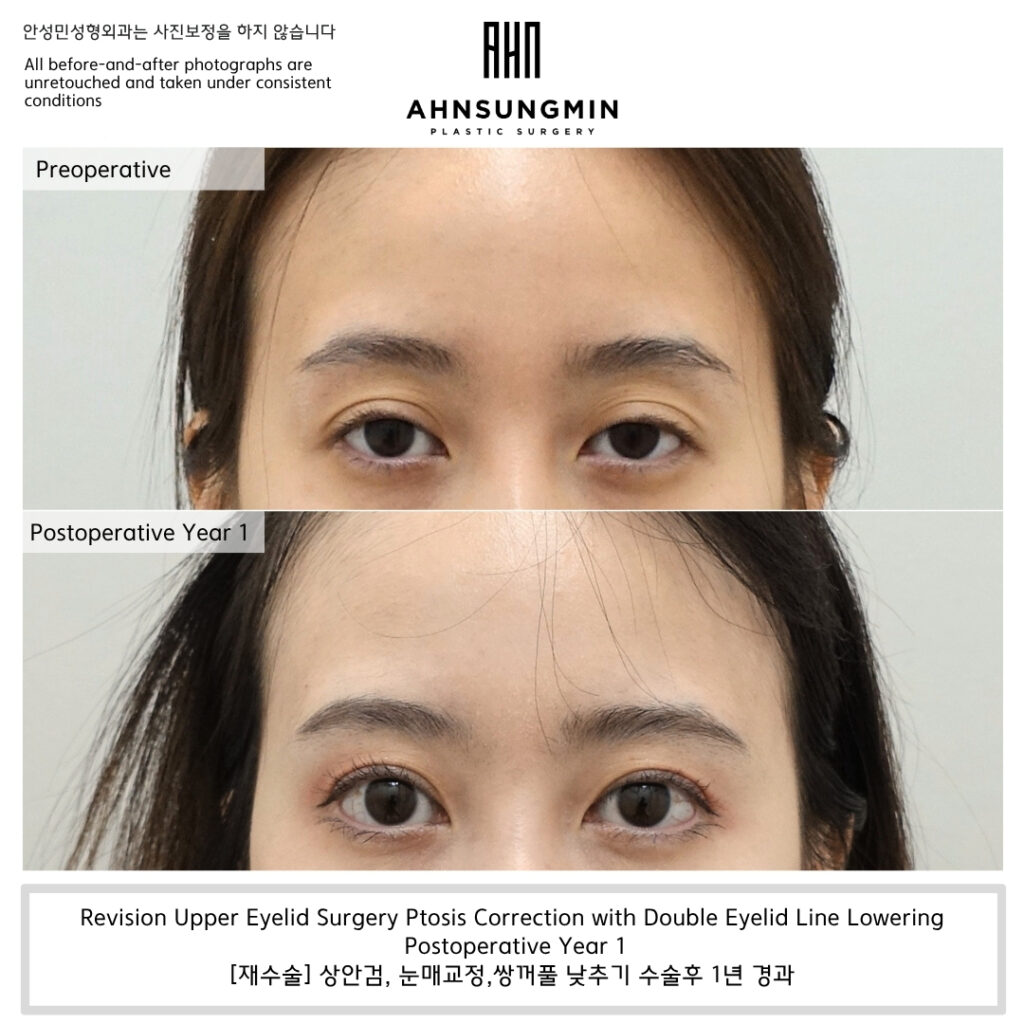 revision-ptosis-double-eyelid-line-lowering-1year.jpg