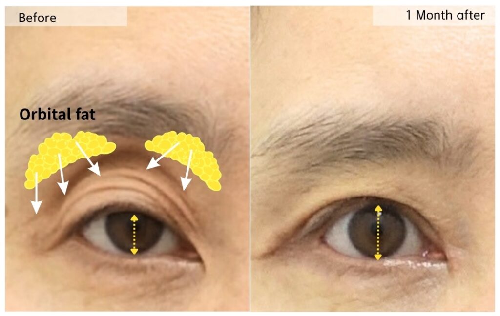 orbital fat repositioning before and after showing improved eye opening and reduced upper eyelid hollowing