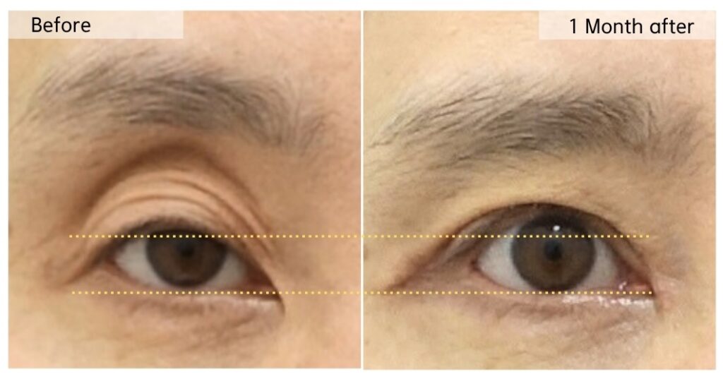 upper eyelid hollowing improvement before and after showing smoother eyelid contour and reduced multiple folds