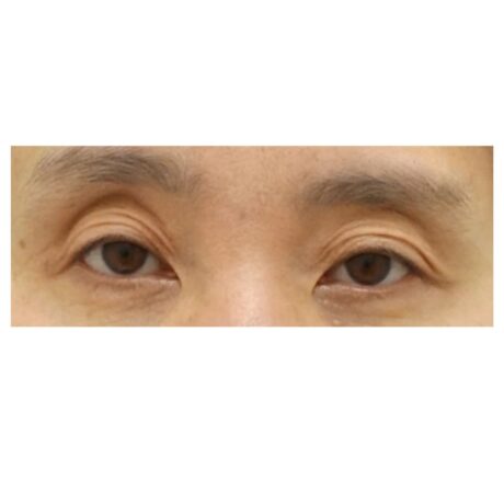 When Is the Right Time for Revision Eyelid Surgery?