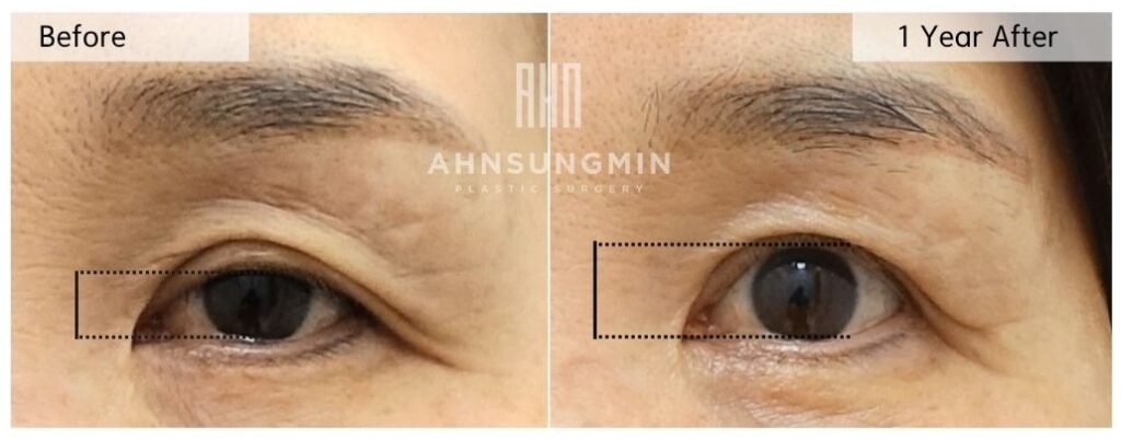 Before and one year after ptosis correction surgery showing improved eyelid opening and more stable upper eyelid function