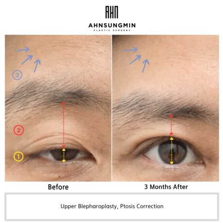 Why Pseudoptosis and True Ptosis Are So Often Confused.