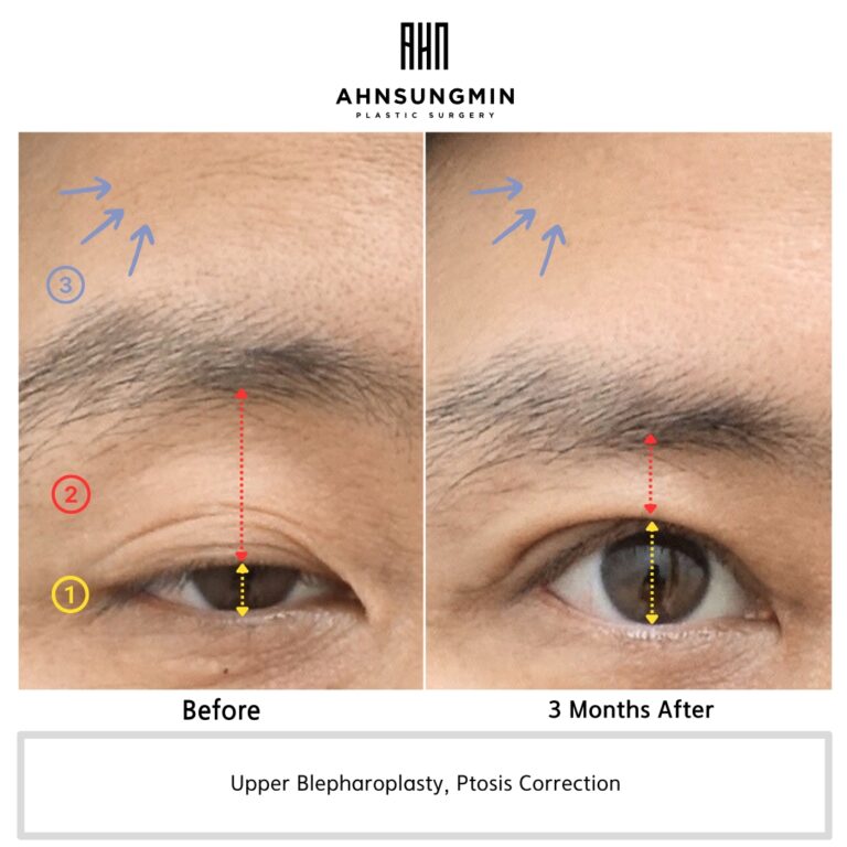 Before and 3 months after ptosis correction surgery showing improved eyelid opening and reduced forehead compensation.