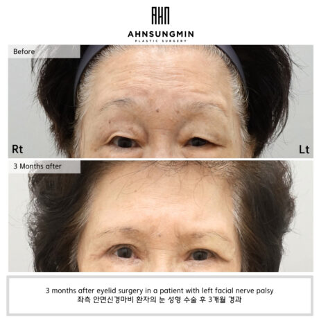 “Eyelid Surgery in Facial Nerve Palsy: Restoring Symmetry Through a Specialized Approach”