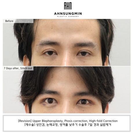 Why Eyelid Function Comes First in High Fold Correction