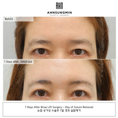Still Feeling Heaviness After Upper Eyelid Surgery?