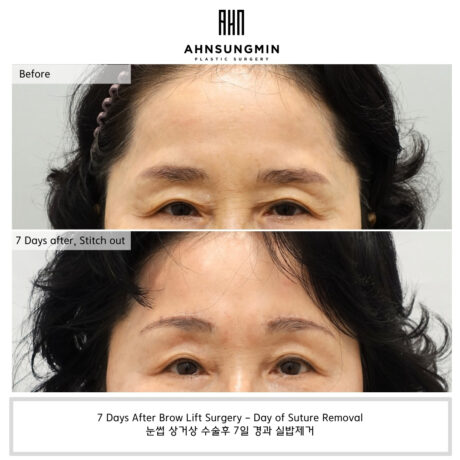 Brow Lift Surgery in Patients in Their 60s:   Improving Comfort Rather Than Eye Size