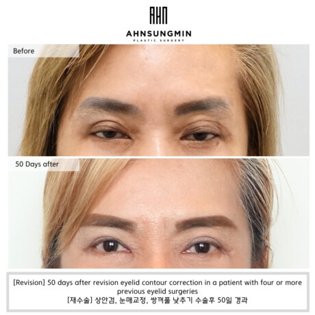 Revision Eyelid Surgery Case: Multiple Folds After Four Previous Surgeries