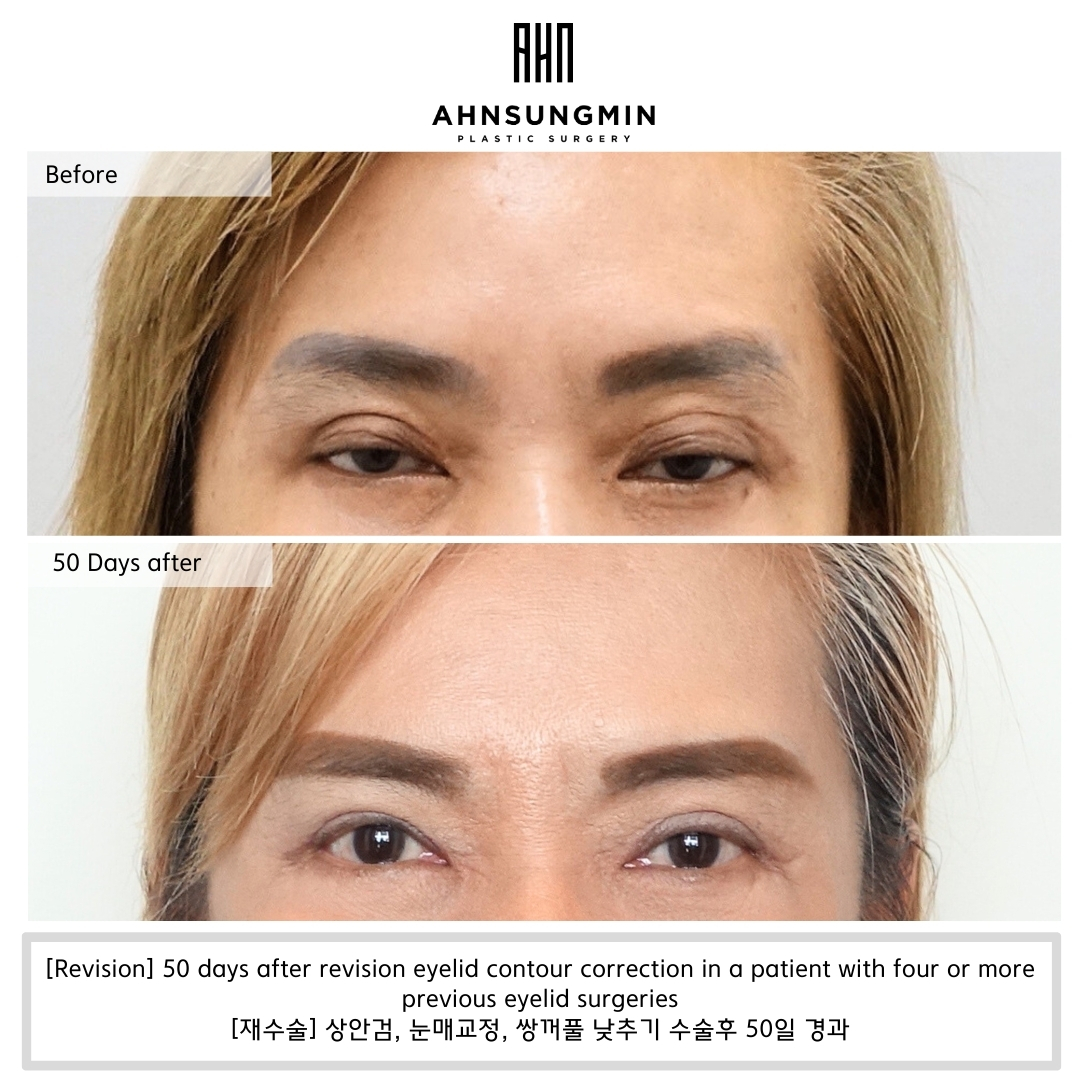 revision eyelid surgery before and after 50 days, correction of multiple eyelid folds after repeated surgeries