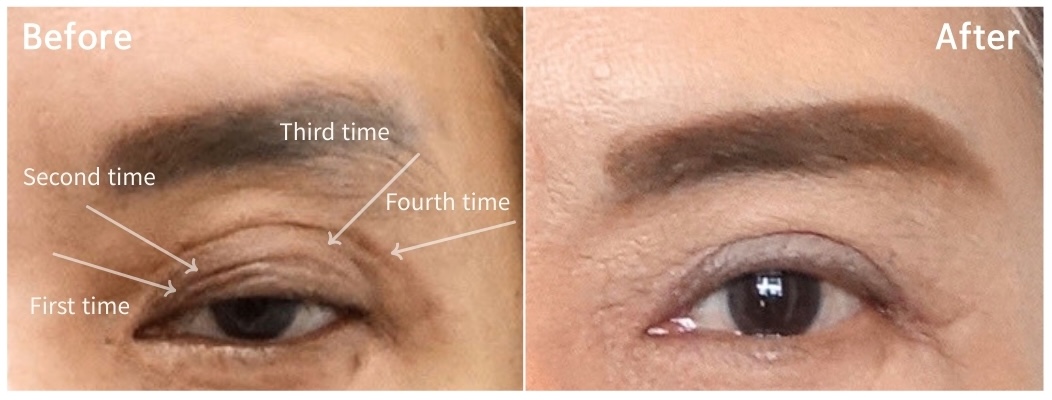 Revision eyelid surgery case showing four previous surgical crease lines before correction and structural improvement after revision surgery in Korea