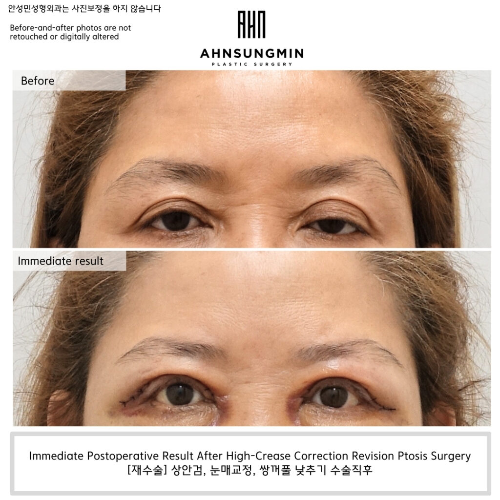 Immediate postoperative result of revision ptosis surgery with high-crease correction, unretouched clinical photograph.