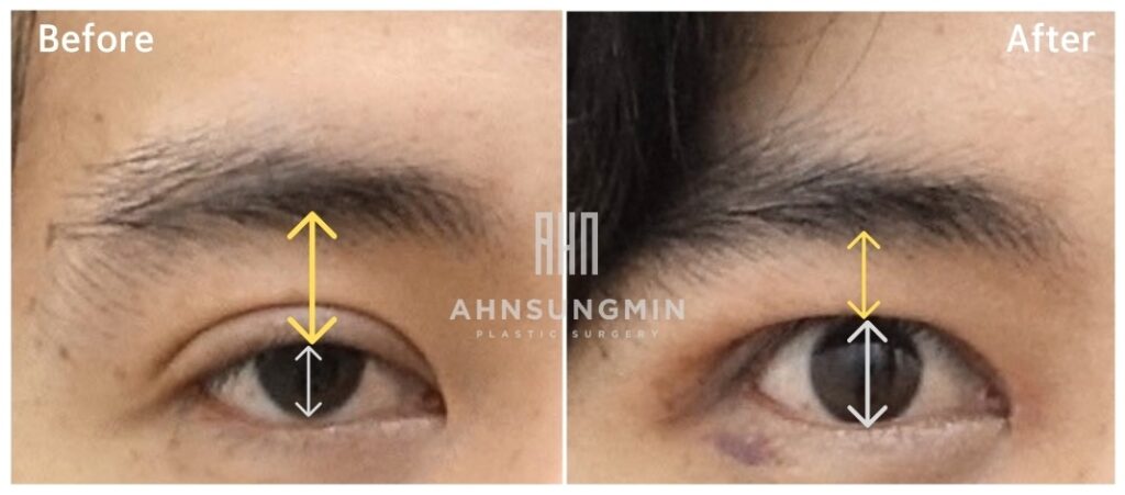 Comparison of pupil exposure before and after ptosis correction
