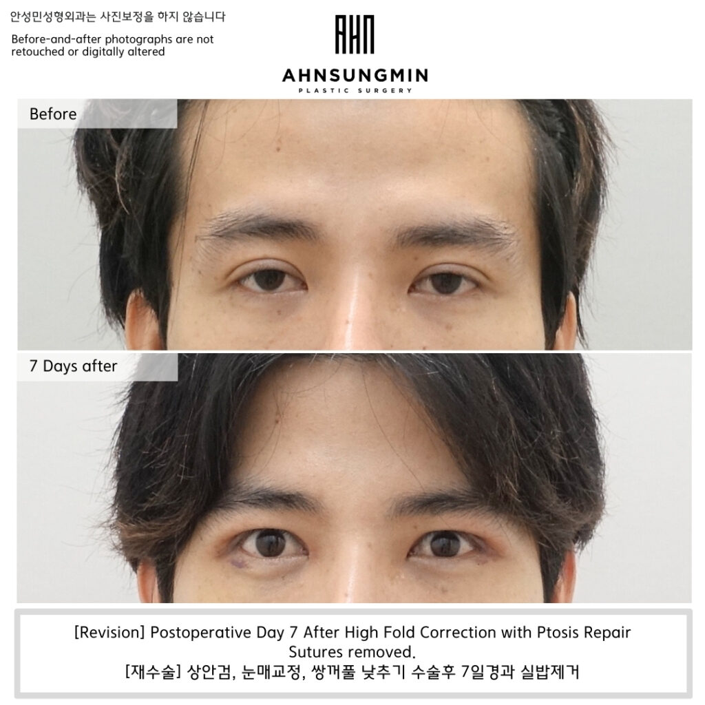 Before and 7 days after high fold correction with ptosis repair