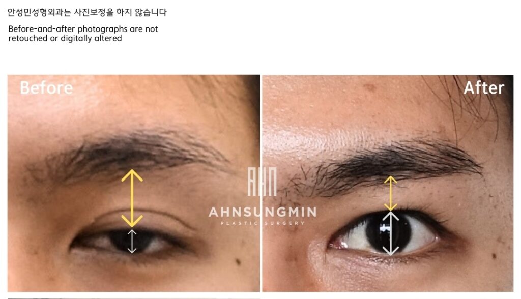 Comparison of pupil exposure before and after ptosis correction