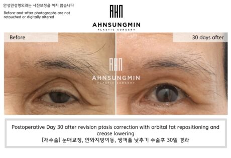 Why We Did Not Use Fat Grafting in This Case of Eyelid Hollowing.