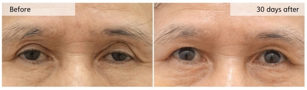 Before and 30 days after revision ptosis correction with orbital fat repositioning and crease lowering